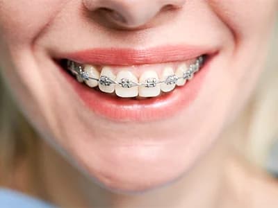 Brackets metálicos, de zafiro y de autoligado