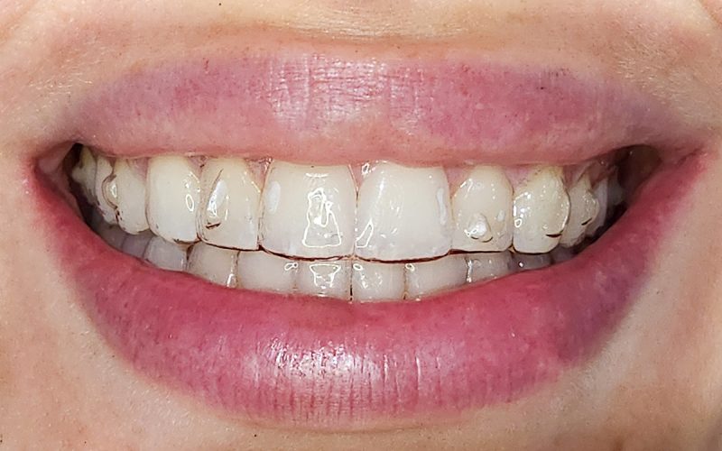 ortodonciaconalineadores-drapatriciaespanol