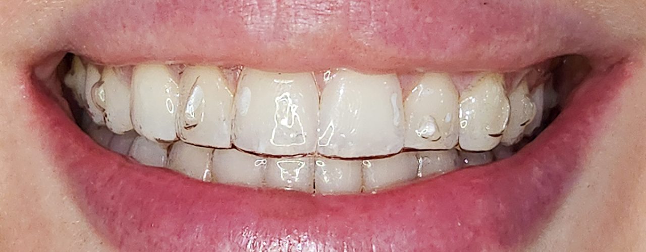 ortodonciaconalineadores-drapatriciaespanol